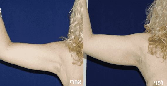 ניתוח עיצוב זרועות – לזרועות מתוחות יותר